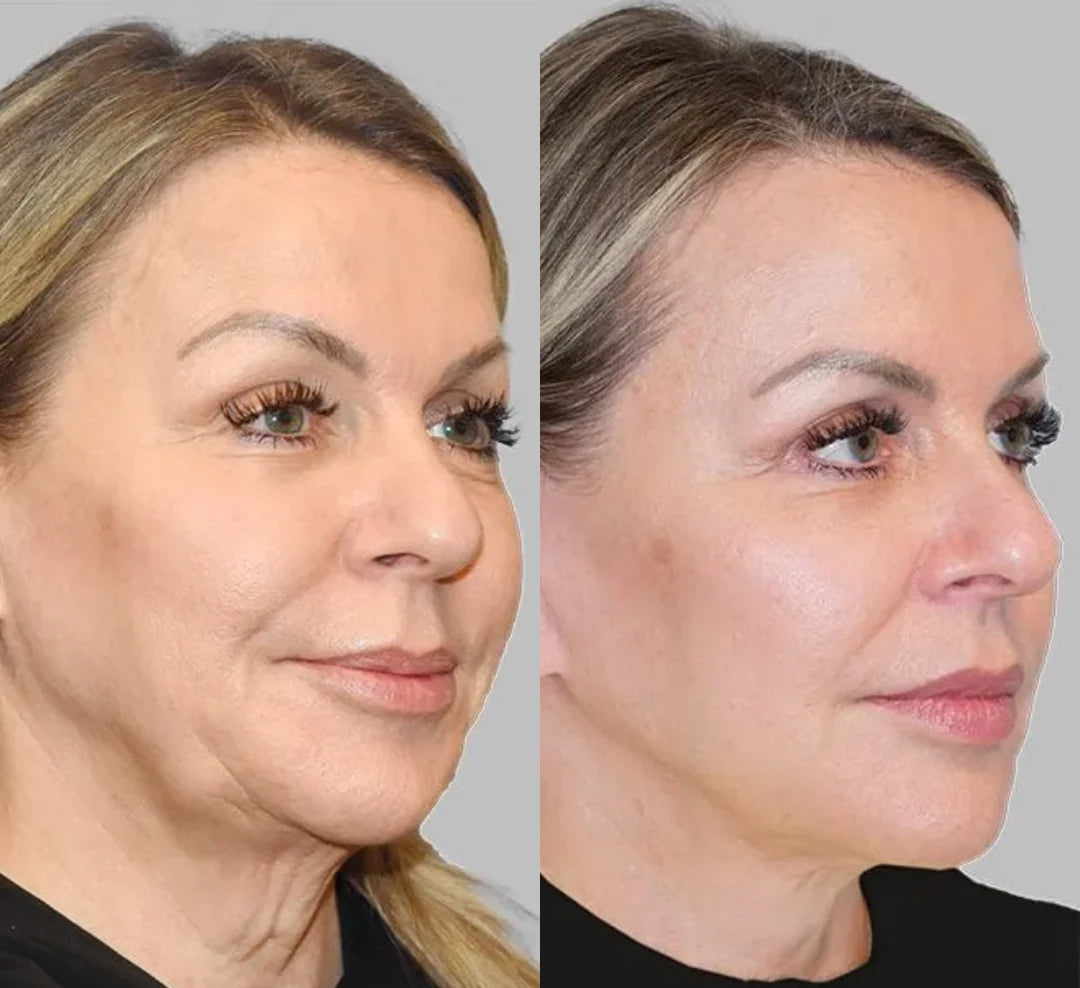 LED Ansiktslyft - Anti-aging hudterapi